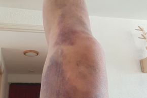 Mein Bein nach dem Sturz am Donnerstag schaut etwas mitgenommen aus, zum Glück nur ein Riesen-Bluterguss. Aber schmerzen tut es trotzdem …